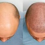 Discover the Best Hair Transplant Options in Dubai: Your Guide to a New Look”